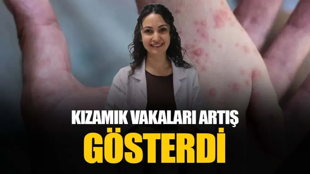 Kızamık vakaları arttı, aşı olmayan çocuklar hastalığı ağır geçiriyor