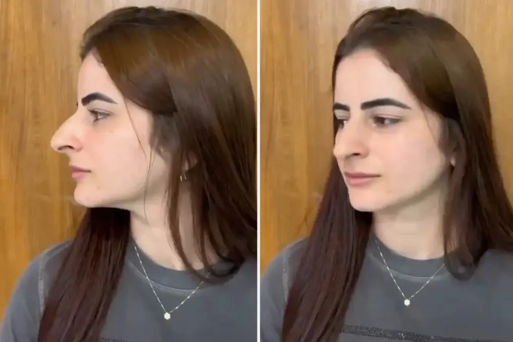 Hevesle burun estetiği oldu ama sonu skandal